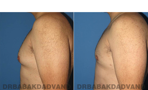 Gynecomastia. Before and After Treatment Photos - male - left side view (patient - 57)