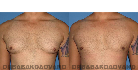 Gynecomastia. Before and After Treatment Photos - male - front view (patient - 58)