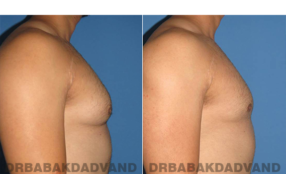 Gynecomastia. Before and After Treatment Photos - male - right side view (patient - 58)