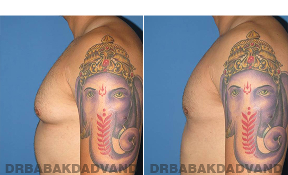 Gynecomastia. Before and After Treatment Photos - male - left side view (patient - 58)