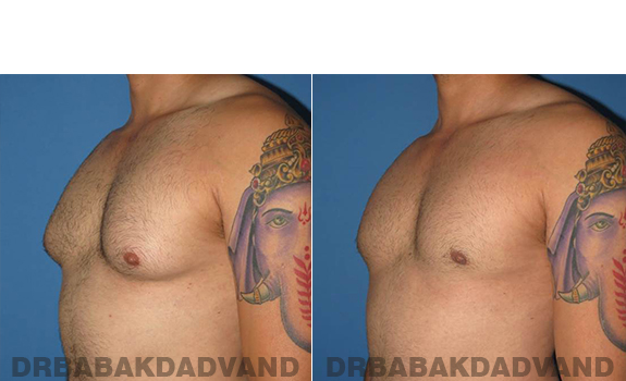 Gynecomastia. Before and After Treatment Photos - male - left side oblique view (patient 58)