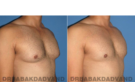 Gynecomastia. Before and After Treatment Photos - male - right side oblique view (patient - 58)