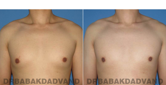 Gynecomastia. Before and After Treatment Photos - male - front view (patient - 59)