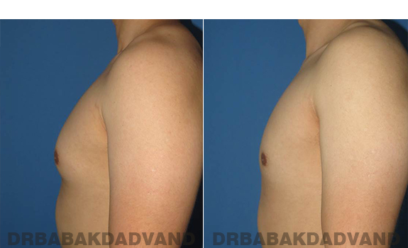Gynecomastia. Before and After Treatment Photos - male - left side view (patient - 59)