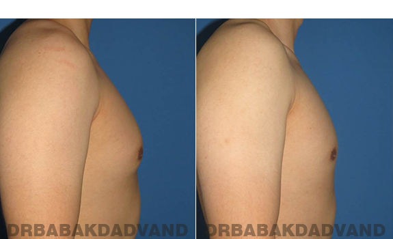 Gynecomastia. Before and After Treatment Photos - male - right side view (patient - 59)