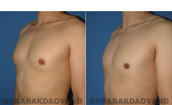 Gynecomastia. Before and After Treatment Photos - male - left side oblique view (patient 59)