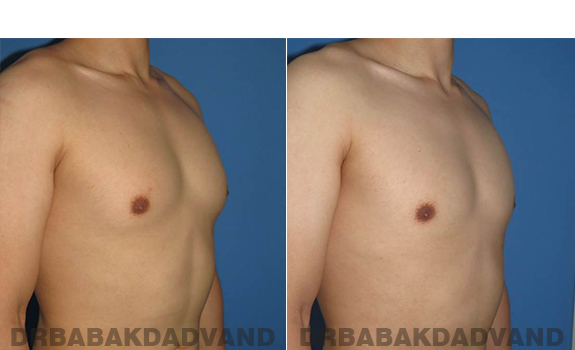 Gynecomastia. Before and After Treatment Photos - male - right side oblique view (patient - 59)