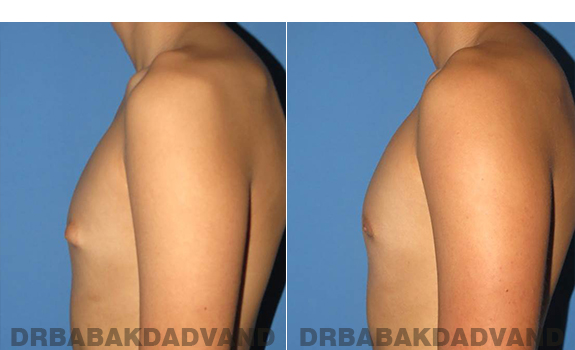 Gynecomastia. Before and After Treatment Photos - male - left side view (patient - 60)