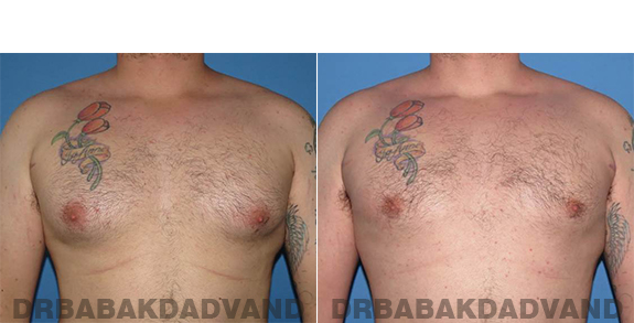 Gynecomastia. Before and After Treatment Photos - male - front view (patient - 61)