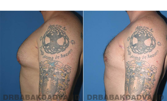 Gynecomastia. Before and After Treatment Photos - male - left side view (patient - 61)
