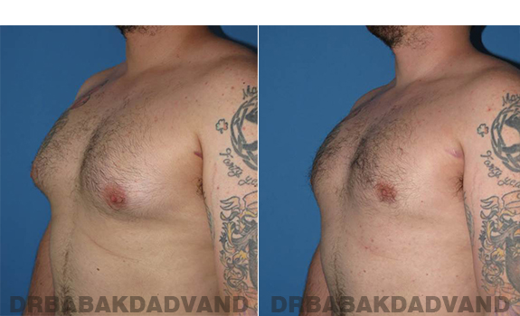 Gynecomastia. Before and After Treatment Photos - male - left side oblique view (patient 61)
