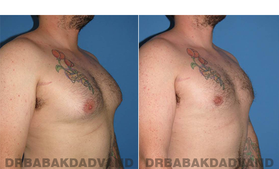 Gynecomastia. Before and After Treatment Photos - male - right side oblique view (patient - 61)