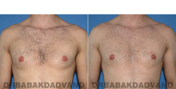 Gynecomastia. Before and After Treatment Photos - male - front view (patient - 62)