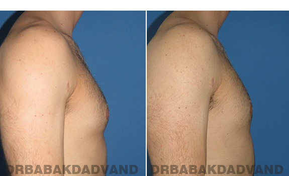 Gynecomastia. Before and After Treatment Photos - male - right side view (patient - 62)