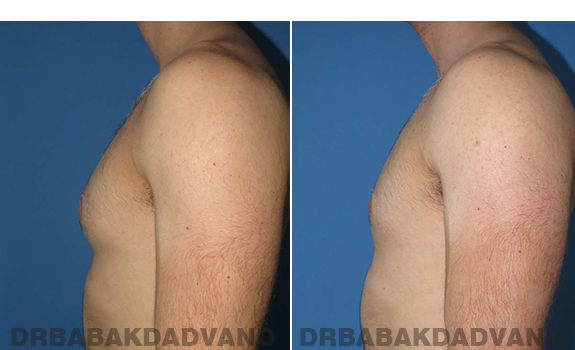 Gynecomastia. Before and After Treatment Photos - male - left side view (patient - 62)