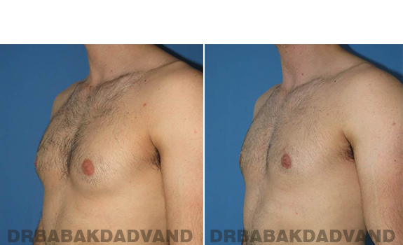 Gynecomastia. Before and After Treatment Photos - male - left side oblique view (patient 62)