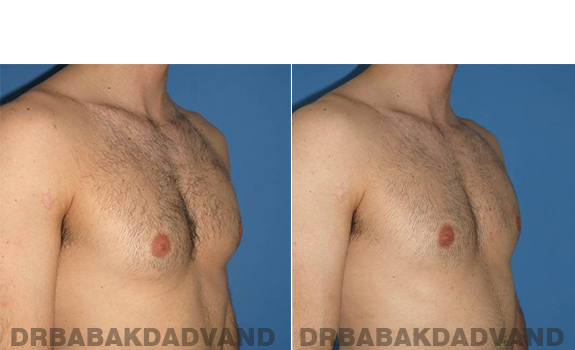 Gynecomastia. Before and After Treatment Photos - male - right side oblique view (patient - 62)