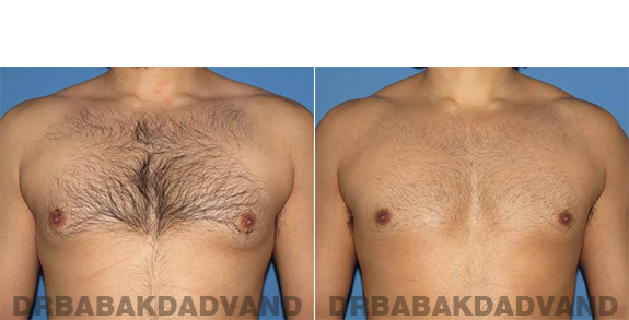 Gynecomastia. Before and After Treatment Photos - male - front view (patient - 63)