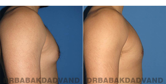 Gynecomastia. Before and After Treatment Photos - male - right side view (patient - 63)