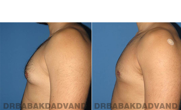 Gynecomastia. Before and After Treatment Photos - male - left side view (patient - 63)