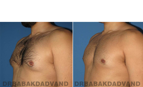 Gynecomastia. Before and After Treatment Photos - male - left side oblique view (patient 63)