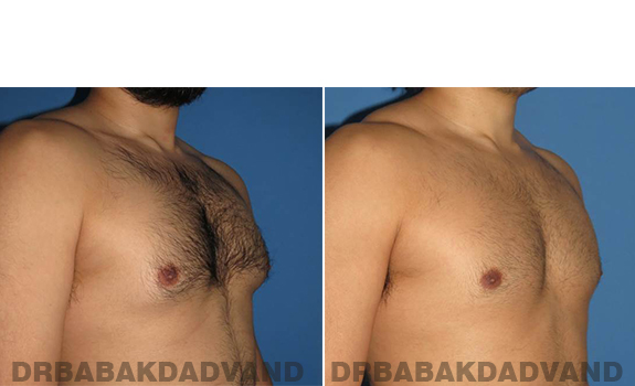 Gynecomastia. Before and After Treatment Photos - male - right side oblique view (patient - 63)