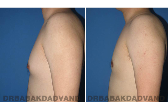 Gynecomastia. Before and After Treatment Photos - male - left side view (patient - 64)