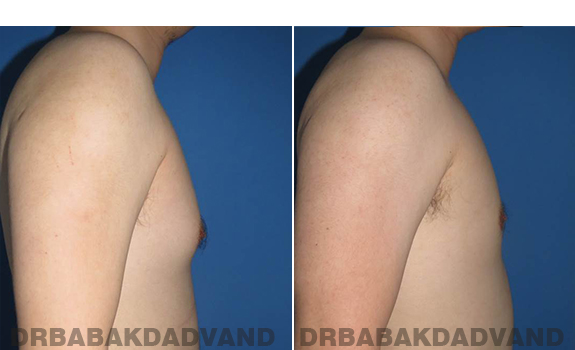 Gynecomastia. Before and After Treatment Photos - male - right side view (patient - 64)