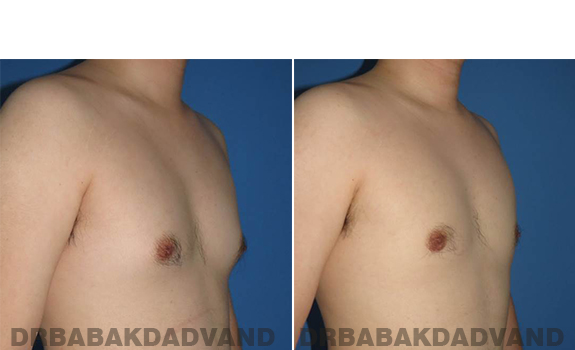 Gynecomastia. Before and After Treatment Photos - male - right side oblique view (patient - 64)