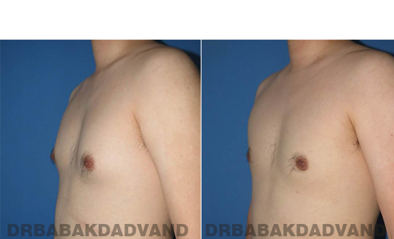Gynecomastia. Before and After Treatment Photos - male - left side oblique view (patient 64)