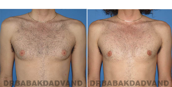 Gynecomastia. Before and After Treatment Photos - male - front view (patient - 65)