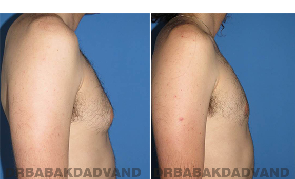 Gynecomastia. Before and After Treatment Photos - male - right side view (patient - 65)