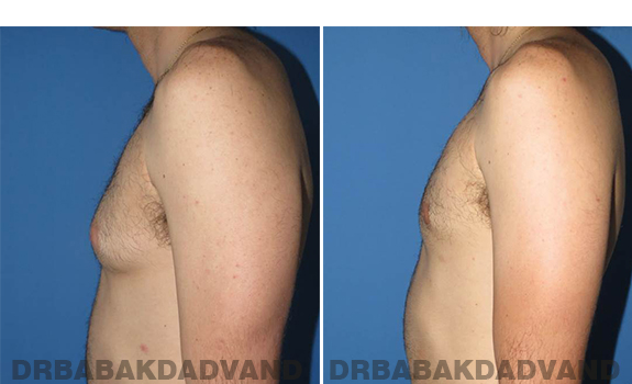 Gynecomastia. Before and After Treatment Photos - male - left side view (patient - 65)