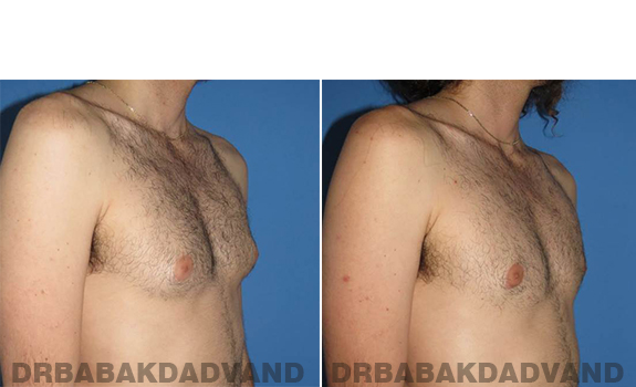 Gynecomastia. Before and After Treatment Photos - male - right side oblique view (patient - 65)