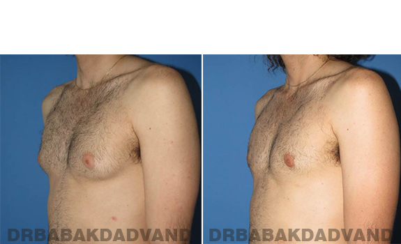 Gynecomastia. Before and After Treatment Photos - male - left side oblique view (patient 65)