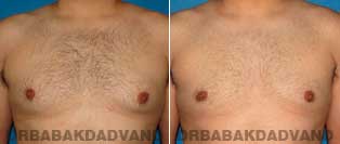 Before and After Treatment Photos - Gynecomastia Surgery - 27 year old, patient