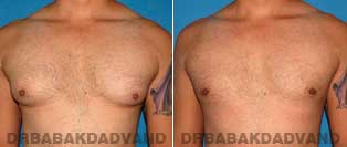 Before and After Treatment Photos - Gynecomastia Surgery - 28 year old, patient