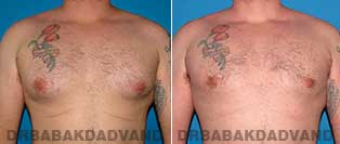 Before and After Treatment Photos - Gynecomastia Surgery - 34 year old, patient