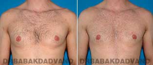 Before and After Treatment Photos - Gynecomastia Surgery - 31 year old, patient