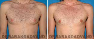 Before and After Treatment Photos - Gynecomastia Surgery - 27 year old,patient