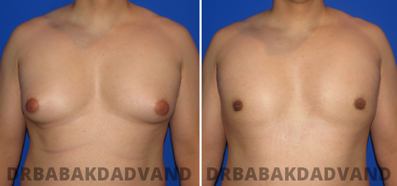 Abdominoplasty. Before and After Treatment Photos - male - front view (patient - 74)