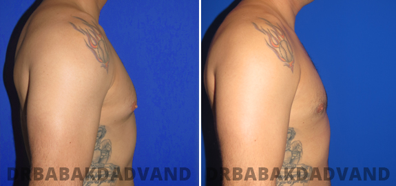Abdominoplasty. Before and After Treatment Photos - male - front view (patient - 74)