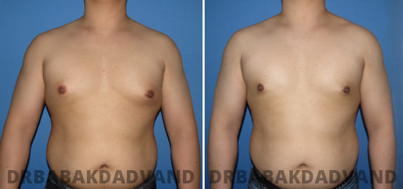 Abdominoplasty. Before and After Treatment Photos - male - front view (patient - 72)