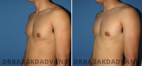 Puffy Nipple. Before and After Treatment Photos - male - front view (patient - 80)