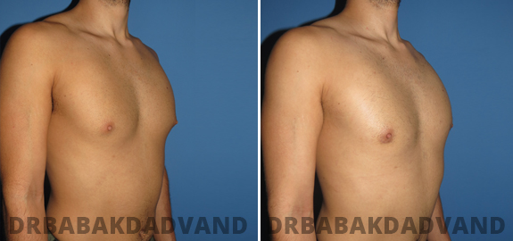 Puffy Nipple. Before and After Treatment Photos - male - front view (patient - 80)