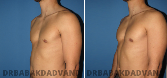 Puffy Nipple. Before and After Treatment Photos - male - front view (patient - 82)