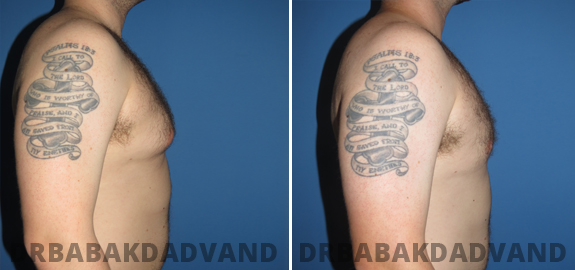 Abdominoplasty. Before and After Treatment Photos - male - front view (patient - 68)