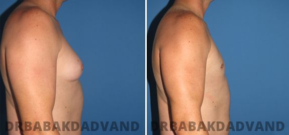 Abdominoplasty. Before and After Treatment Photos - male - front view (patient - 69)