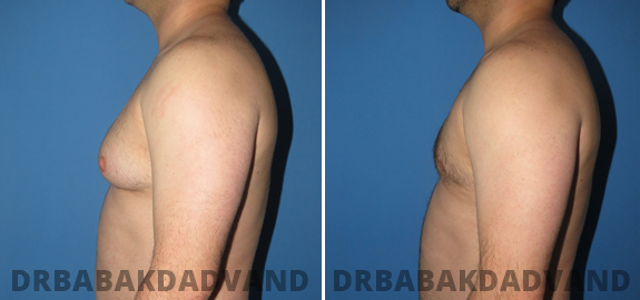 Abdominoplasty. Before and After Treatment Photos - male - front view (patient - 70)