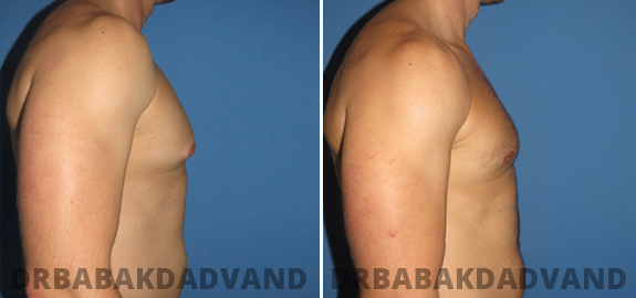 Abdominoplasty. Before and After Treatment Photos - male - front view (patient - 71)